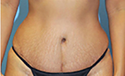 Tummy Tuck Before and After Pictures Plano, TX