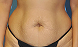 Tummy Tuck Before and After Pictures Plano, TX