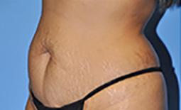 Tummy Tuck Before and After Pictures Plano, TX