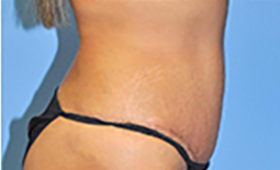 Tummy Tuck Before and After Pictures Plano, TX