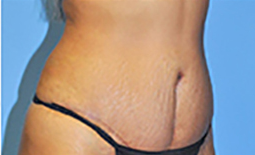 Tummy Tuck Before and After Pictures Plano, TX