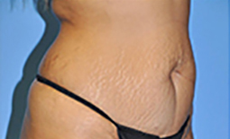 Tummy Tuck Before and After Pictures Plano, TX