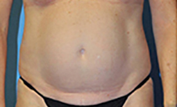 Tummy Tuck Before and After Pictures Plano, TX