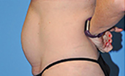 Tummy Tuck Before and After Pictures Plano, TX