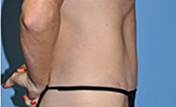 Tummy Tuck Before and After Pictures Plano, TX