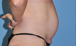 Tummy Tuck Before and After Pictures Plano, TX