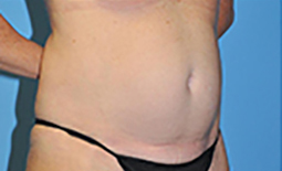 Tummy Tuck Before and After Pictures Plano, TX