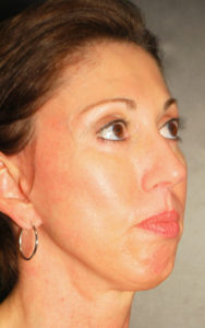 Blepharoplasty Before and After Pictures Plano, TX