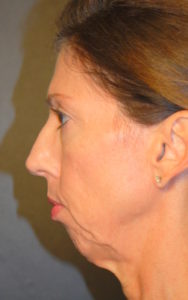 Blepharoplasty Before and After Pictures Plano, TX