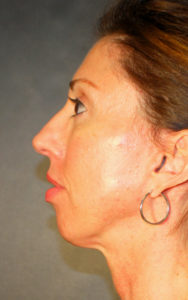 Blepharoplasty Before and After Pictures Plano, TX