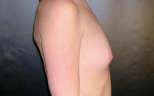 Breast Augmentation Before and After Pictures Plano, TX