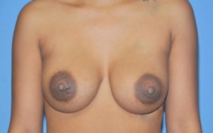 Breast Augmentation Before and After Pictures Plano, TX