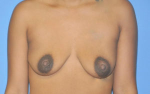 Breast Augmentation Before and After Pictures Plano, TX