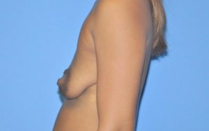 Breast Augmentation Before and After Pictures Plano, TX