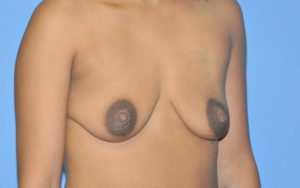 Breast Augmentation Before and After Pictures Plano, TX