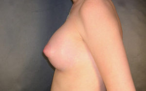 Breast Augmentation Before and After Pictures Plano, TX