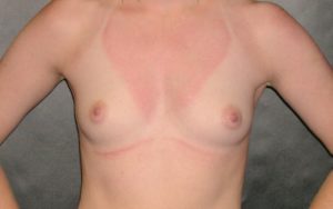 Breast Augmentation Before and After Pictures Plano, TX