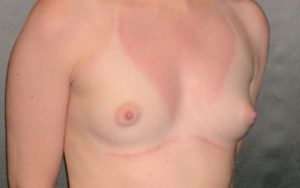 Breast Augmentation Before and After Pictures Plano, TX