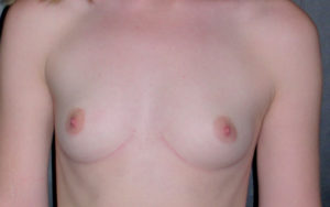 Breast Augmentation Before and After Pictures Plano, TX