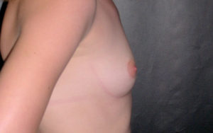 Breast Augmentation Before and After Pictures Plano, TX
