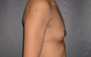 Breast Augmentation Before and After Pictures Plano, TX