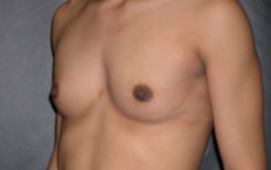 Breast Augmentation Before and After Pictures Plano, TX