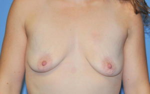 Breast Augmentation Before and After Pictures Plano, TX