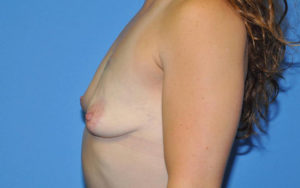 Breast Augmentation Before and After Pictures Plano, TX