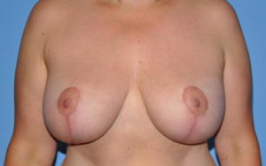 Breast Lift Before and After Pictures Plano, TX