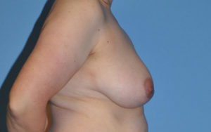 Breast Lift Before and After Pictures Plano, TX