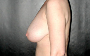 Breast Reduction Before and After Pictures Plano, TX