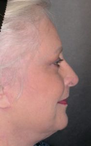 Facelift Before and After Pictures Plano, TX