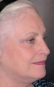 Facelift Before and After Pictures Plano, TX