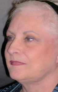 Facelift Before and After Pictures Plano, TX