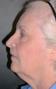 Facelift Before and After Pictures Plano, TX