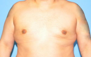 Gynecomastia Before and After Pictures Plano, TX