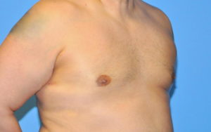 Gynecomastia Before and After Pictures Plano, TX