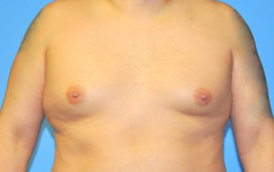 Gynecomastia Before and After Pictures Plano, TX