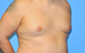 Gynecomastia Before and After Pictures Plano, TX