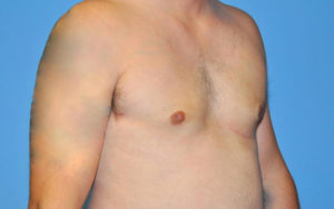 Gynecomastia Before and After Pictures Plano, TX