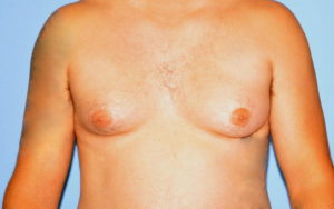 Gynecomastia Before and After Pictures Plano, TX