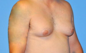 Gynecomastia Before and After Pictures Plano, TX