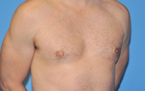 Gynecomastia Before and After Pictures Plano, TX