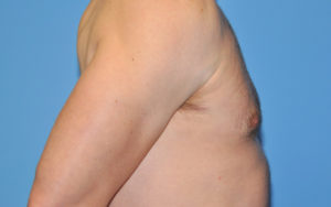 Gynecomastia Before and After Pictures Plano, TX