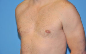 Gynecomastia Before and After Pictures Plano, TX