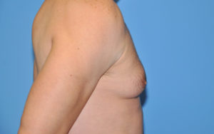 Gynecomastia Before and After Pictures Plano, TX