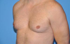 Gynecomastia Before and After Pictures Plano, TX