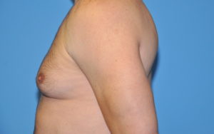 Gynecomastia Before and After Pictures Plano, TX