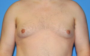 Gynecomastia Before and After Pictures Plano, TX