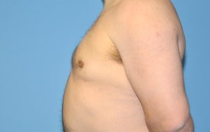 Gynecomastia Before and After Pictures Plano, TX